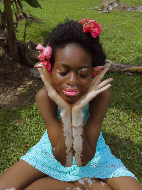 Mulher com manchas de vitiligo no rosto sorrindo, representando a autoestima feminina e beleza real.