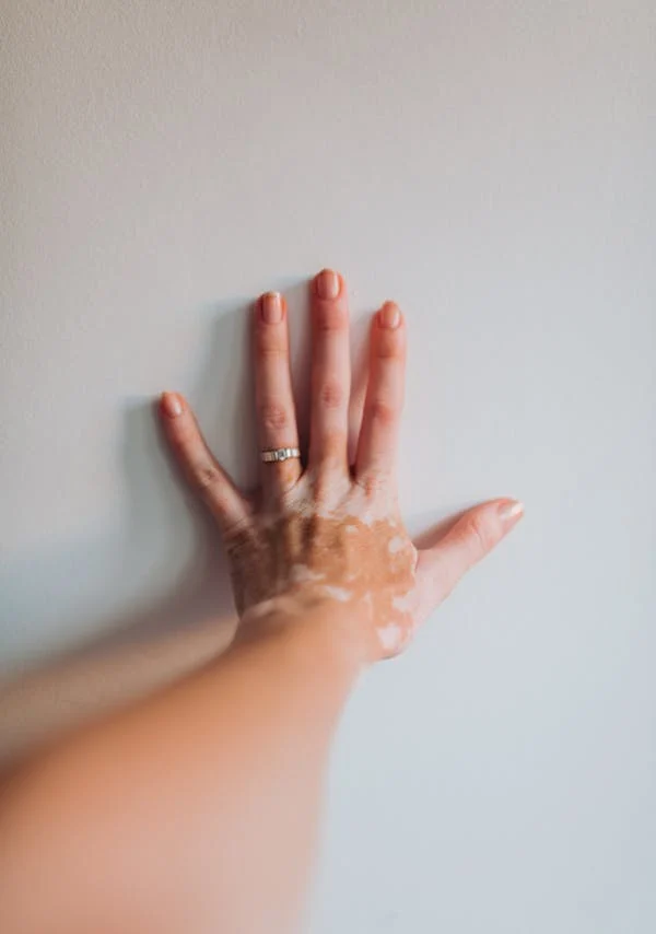 vitiligo1