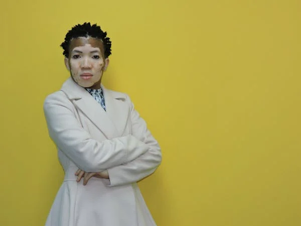 vitiligo6