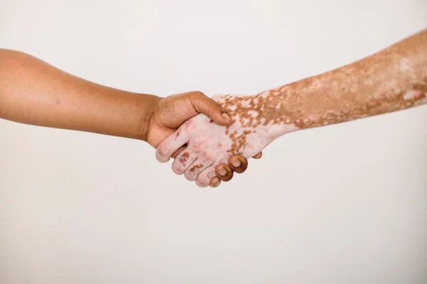 vitiligo-5
