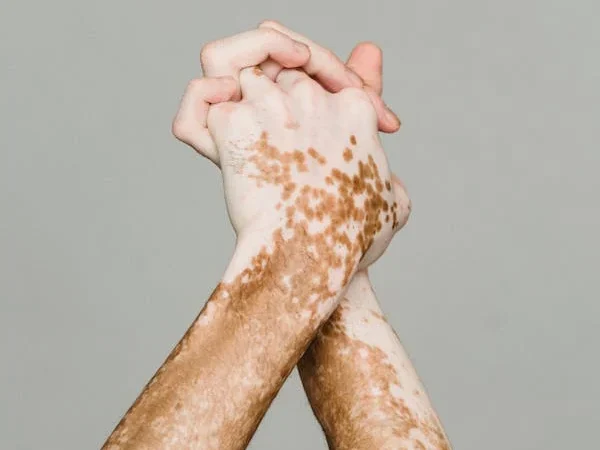 Vitiligo: A Beleza da Diversidade e a Autenticidade