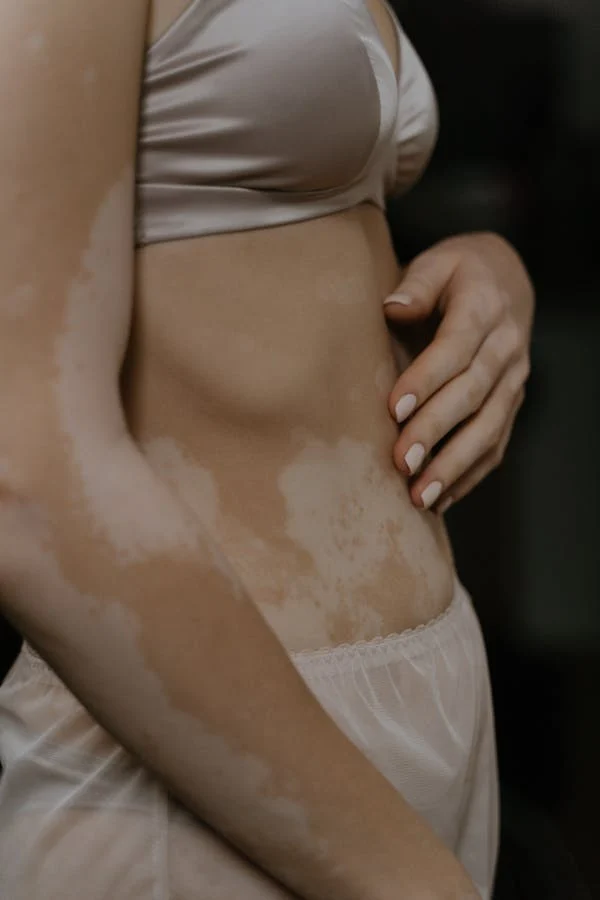 vitiligo7