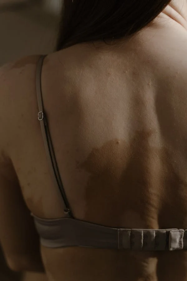 vitiligo4